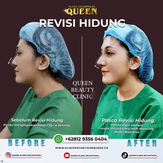 Hasil Rhinoplasty Queen Plastic Surgery, foto 15