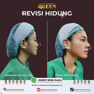 Hasil Rhinoplasty Queen Plastic Surgery, foto 13