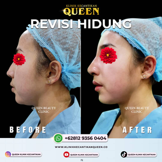 Hasil Rhinoplasty Queen Plastic Surgery, foto 12