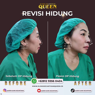 Hasil Rhinoplasty Queen Plastic Surgery, foto 11