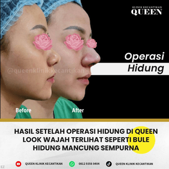 Hasil Rhinoplasty Queen Plastic Surgery, foto 10