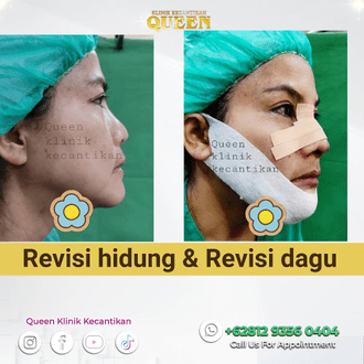 Hasil Rhinoplasty Queen Plastic Surgery, foto 9
