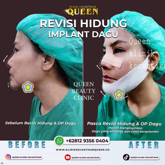 Hasil Rhinoplasty Queen Plastic Surgery, foto 8