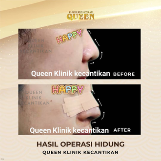 Hasil Rhinoplasty Queen Plastic Surgery, foto 7