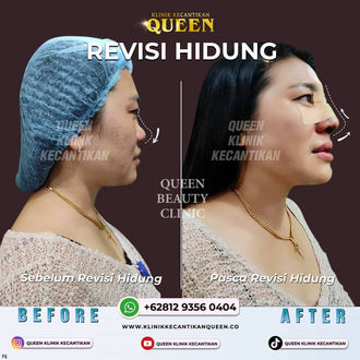 Hasil Rhinoplasty Queen Plastic Surgery, foto 95