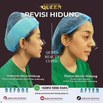 Hasil Rhinoplasty Queen Plastic Surgery, foto 96