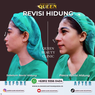 Hasil Rhinoplasty Queen Plastic Surgery, foto 97