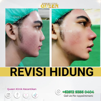 Hasil Rhinoplasty Queen Plastic Surgery, foto 98