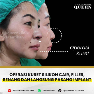 Hasil Rhinoplasty Queen Plastic Surgery, foto 99