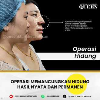 Hasil Rhinoplasty Queen Plastic Surgery, foto 100