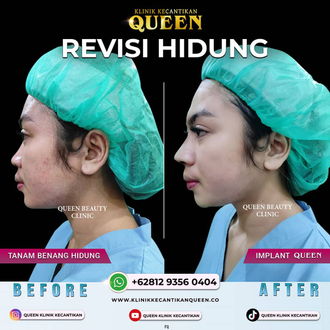 Hasil Rhinoplasty Queen Plastic Surgery, foto 1