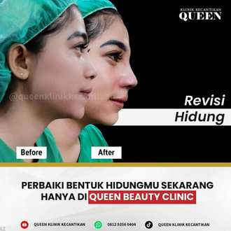 Hasil Rhinoplasty Queen Plastic Surgery, foto 2