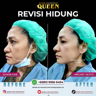Hasil Rhinoplasty Queen Plastic Surgery, foto 3