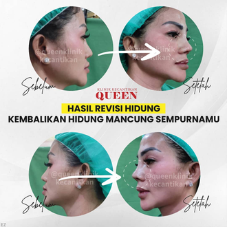 Hasil Rhinoplasty Queen Plastic Surgery, foto 4