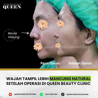 Hasil Rhinoplasty Queen Plastic Surgery, foto 5