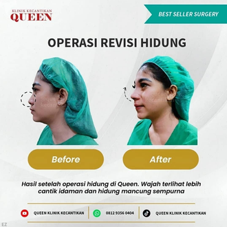 Hasil Rhinoplasty Queen Plastic Surgery, foto 6