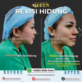 Hasil Rhinoplasty Queen Plastic Surgery, foto 94