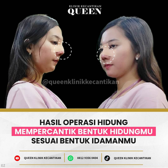 Hasil Rhinoplasty Queen Plastic Surgery, foto 93