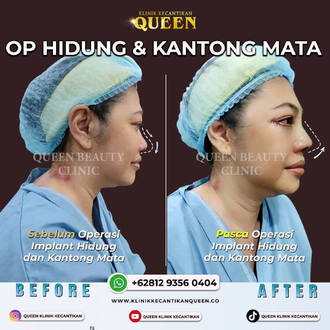 Hasil Rhinoplasty Queen Plastic Surgery, foto 92