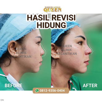 Hasil Rhinoplasty Queen Plastic Surgery, foto 91