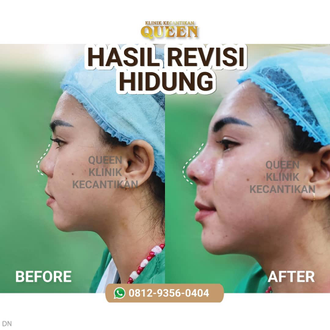 Hasil Rhinoplasty Queen Plastic Surgery, foto 90