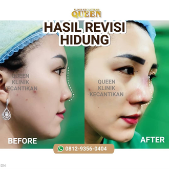 Hasil Rhinoplasty Queen Plastic Surgery, foto 89