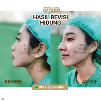 Hasil Rhinoplasty Queen Plastic Surgery, foto 88