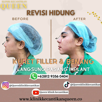 Hasil Rhinoplasty Queen Plastic Surgery, foto 87