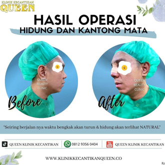 Hasil Rhinoplasty Queen Plastic Surgery, foto 86