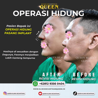 Hasil Rhinoplasty Queen Plastic Surgery, foto 85