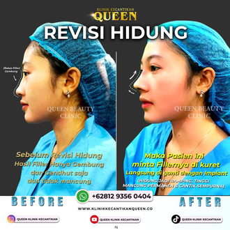 Hasil Rhinoplasty Queen Plastic Surgery, foto 84