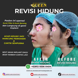 Hasil Rhinoplasty Queen Plastic Surgery, foto 72