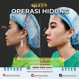 Hasil Rhinoplasty Queen Plastic Surgery, foto 73