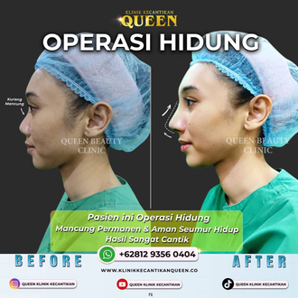 Hasil Rhinoplasty Queen Plastic Surgery, foto 74