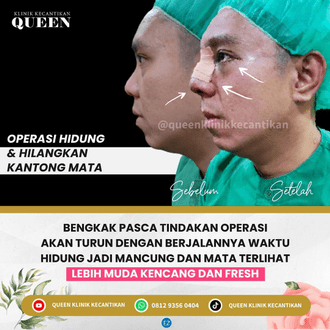 Hasil Rhinoplasty Queen Plastic Surgery, foto 78