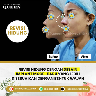 Hasil Rhinoplasty Queen Plastic Surgery, foto 79