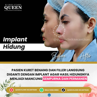 Hasil Rhinoplasty Queen Plastic Surgery, foto 80