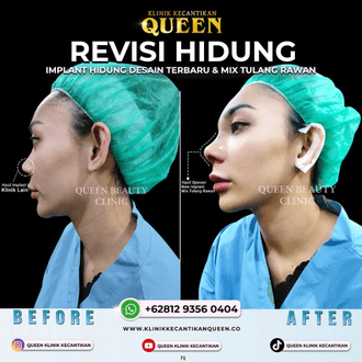 Hasil Rhinoplasty Queen Plastic Surgery, foto 81