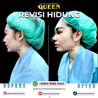 Hasil Rhinoplasty Queen Plastic Surgery, foto 82
