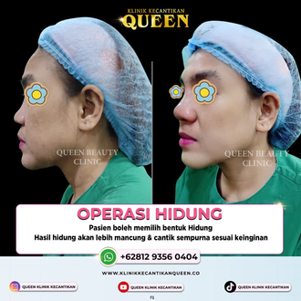 Hasil Rhinoplasty Queen Plastic Surgery, foto 70