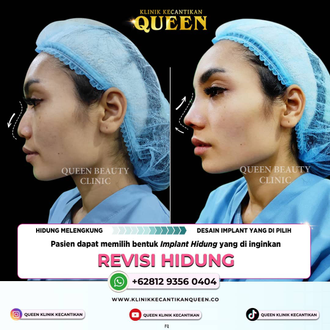 Hasil Rhinoplasty Queen Plastic Surgery, foto 69