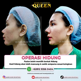Hasil Rhinoplasty Queen Plastic Surgery, foto 68