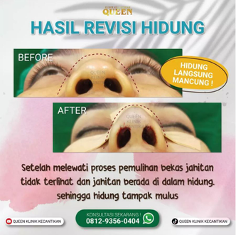 Hasil Rhinoplasty Queen Plastic Surgery, foto 67
