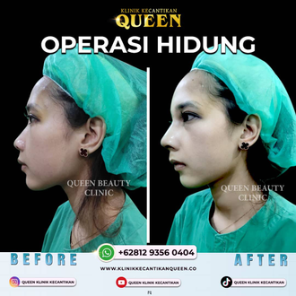 Hasil Rhinoplasty Queen Plastic Surgery, foto 66
