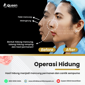 Hasil Rhinoplasty Queen Plastic Surgery, foto 65