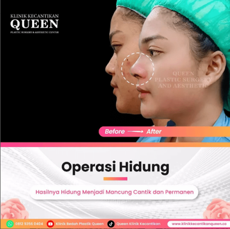 Hasil Rhinoplasty Queen Plastic Surgery, foto 64