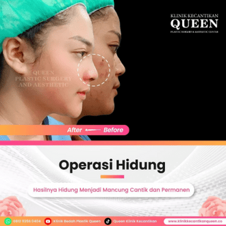 Hasil Rhinoplasty Queen Plastic Surgery, foto 63