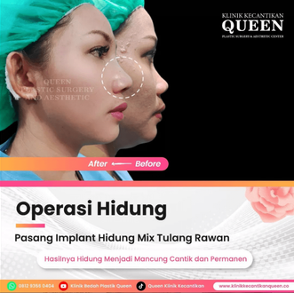Hasil Rhinoplasty Queen Plastic Surgery, foto 62