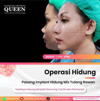 Hasil Rhinoplasty Queen Plastic Surgery, foto 61