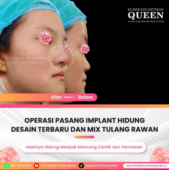 Hasil Rhinoplasty Queen Plastic Surgery, foto 60